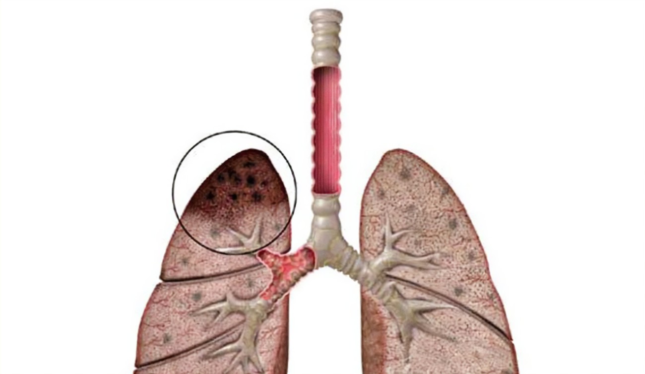 肺結(jié)核篩查做什么檢查？