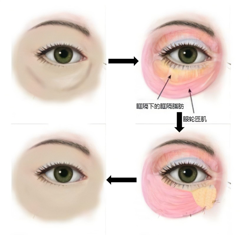 消除眼袋的方法有哪些？