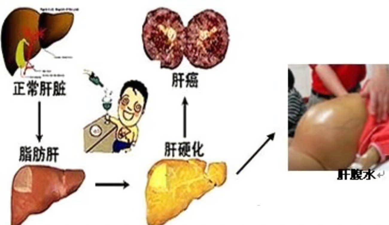 查出肝硬化還有救嗎？