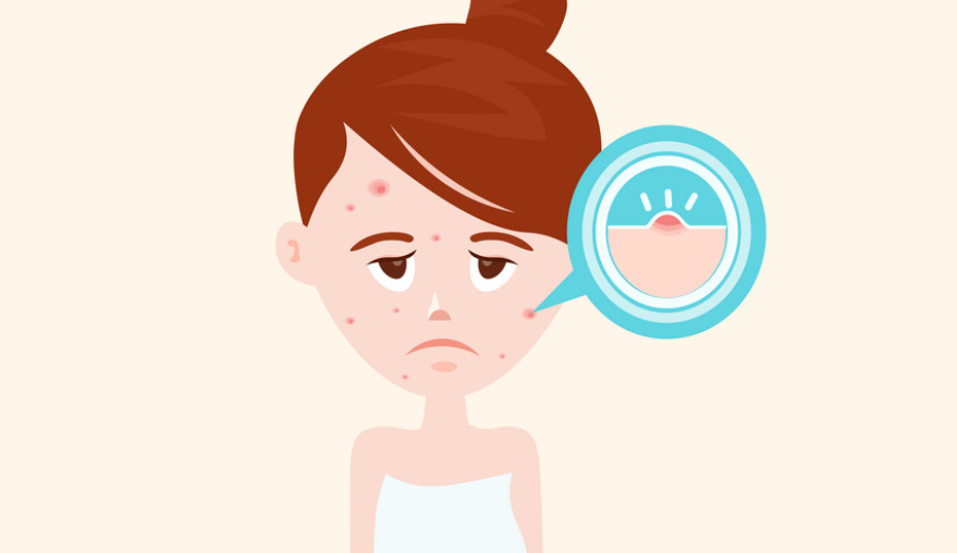 青春痘有救了嗎？聽說(shuō)青春痘也有疫苗了？